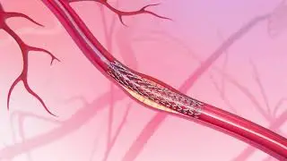 Stent Placement