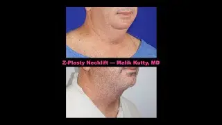 Z-Plasty Necklift--Dr. Kutty