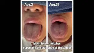 ALS medical doctor recovery record