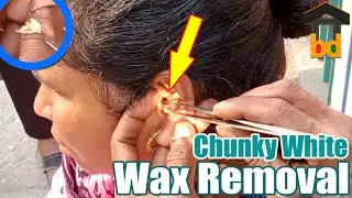 ►50 years Aunt is so Happy after Cleaning both Ear II She Got Relaxation by Little Money