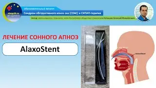 #51: Лечение остановок дыхания во сне  с помощью AlaxoStent | СОАС и СИПАП-терапия