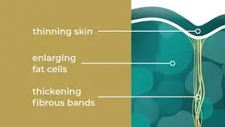 QWO Cellulite Treatment