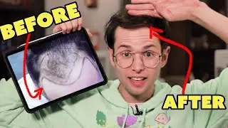 How I Fixed My Balding (One Year After Surgery)