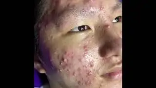 Treatment of acne tablets, pustules and blackheads _COMPLETE_2021