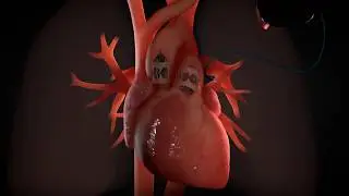 MI-VAD Ventricular Assist Device  Animation