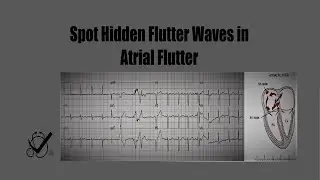 Atrial Flutter- How to Spot Hidden Flutter Waves