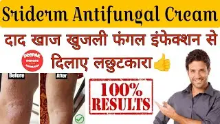 Sriderm Cream फंगस और इंफेक्शन से बचाए  #fungalinfection