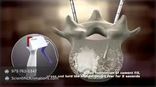 Bone Cement Procedure - Spine Animation