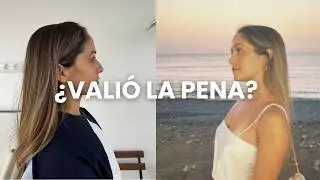 THE TRUTH ABOUT MY RHINOPLASTY - 1 YEAR LATER