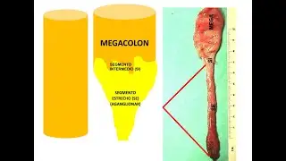 HIRSCHSPRUNG Causas de la enfermedad / Constipación orgánica