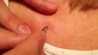 Grandmas black zit