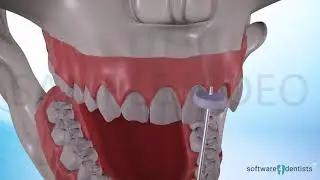 Cosmetic dentistry procedure animation