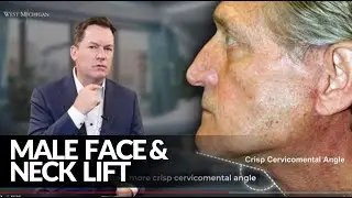 Male Face And Neck Lift - 70 Years Old