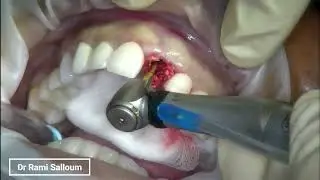 Partial Extraction Therapy: The Optimal Choice for Replacing a Broken Tooth | Dental Implants