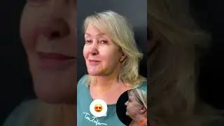 Привели в порядок шею после пластики лица #платизмопластика