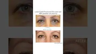 Skin Rejuvenation - Why Multiple Collagen Treatments are Best 