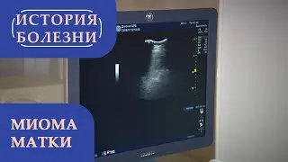 «История болезни». Миома матки
