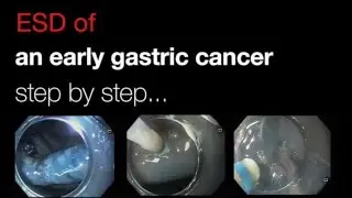 Step by step ESD of an early gastric cancer of the angulus