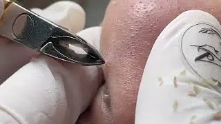 Clip to remove nose pimples - Acne Treatments Mai Ngoc 💕💕💕