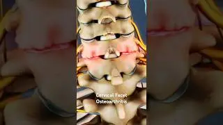 Cervical Facet Osteoarthritis