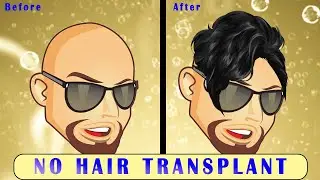 How My Friend Grew His Hair Back WITHOUT A Transplant!