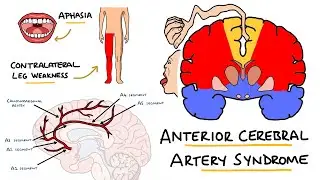 Anterior Cerebral Artery Stroke Syndrome -  ACA Stroke Syndrome | Stroke Syndromes