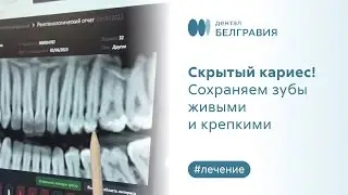 😬 Скрытый кариес! Сохраняем зубы живыми и крепкими