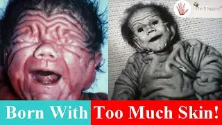 Australian Born With Too Much Skin: Watch Tomm Tennent Transformation! ~ Body Bizarre!