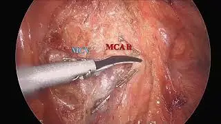 Novel Approach towards MIS for Mid-Transverse Colon Cancer: "Moving the Left Colon" Technique