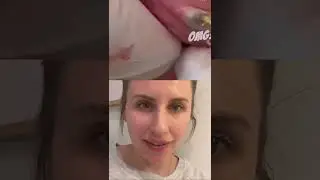 Absolutely Textbook Blackhead Removal