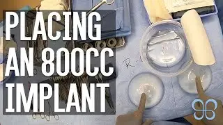 Placing a Large 800cc Breast Implant (Uncensored Surgery Footage)  | Brown Plastic Surgery