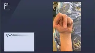 Травма сухожилий сгибателей