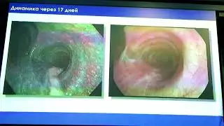 Бронхо 30 02 Сивокозов ИВ Первый опыт применения EVIS X1 в диагностике и лечении ТБ бронха