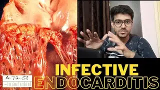 INFECTIVE ENDOCARDITIS-Signs| Symptoms|Pathophysiology #endocarditis #medico