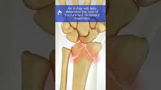Understand Wrist Fractures - 3D Animation  