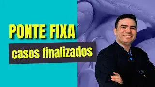 Ponte fixa adesiva em fibra vidro