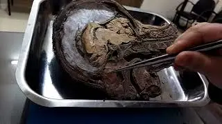 A Realistic Look at Falx Cerebri and Tentorium Cerebelli Through Cadaver Dissection