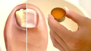 Nail Fungus Removal: 100% Natural Treatment For Toenail Fungus