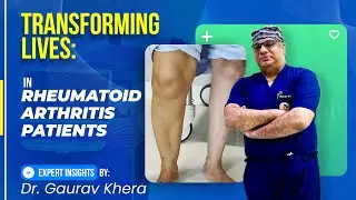 Rheumatoid Arthritis Sufferers REJOICE! Deformity Correction is Possible!