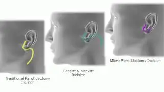 Micro Parotidectomy & Facial Reconstruction | Babak Azizzadeh, MD, FACS