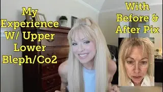 My Experience with Upper & Lower Blepharoplasty 2022, Co2 - What You'll Need-Before & After Pictures