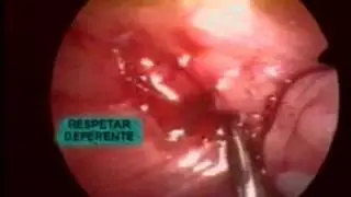 Criptorquidia Videolaparoscopía (T2)