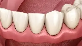 COMO É FEITA A DENTADURA?