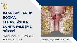 Basurun Lastik Boğma Tedavisinden Sonra İyileşme Süreci -IDEA Klinik