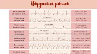 Norm and pathology on ECG: Rhythm disturbances