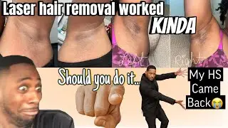 Laser Hair Removal Update with HS or Hidradenitis suppurativa at Ideal Image