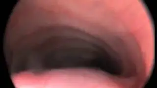 The collapse of the trachea
