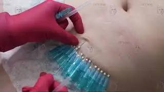 Подтяжка кожи живота нитями