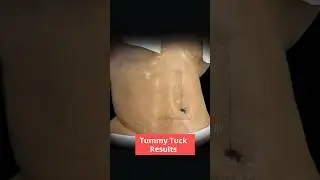 Tummy Tuck Before After Results | Abdominoplasty | Immediate Before After | SB Aesthetics
