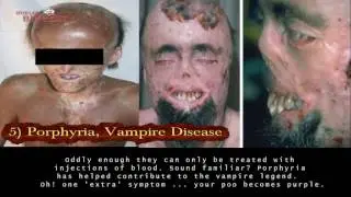 Top 5 Rare, Horrific and Weirdest Diseases - Vampire